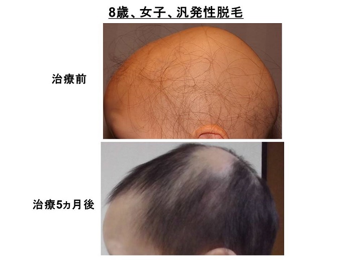 円形脱毛症　病院""